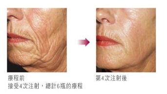 Sculptra案例3.jpg Sculptra案例3.jpg
