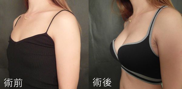 【果凍矽膠隆乳案例】產後不再憂鬱，喚回產前自信｜菲仕美整形外科診所