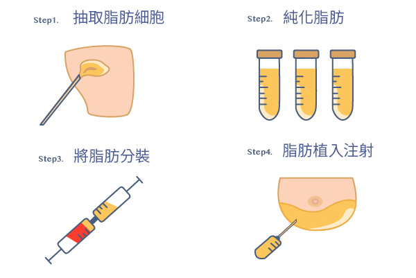 自體脂肪隆乳步驟-菲仕美案例分享