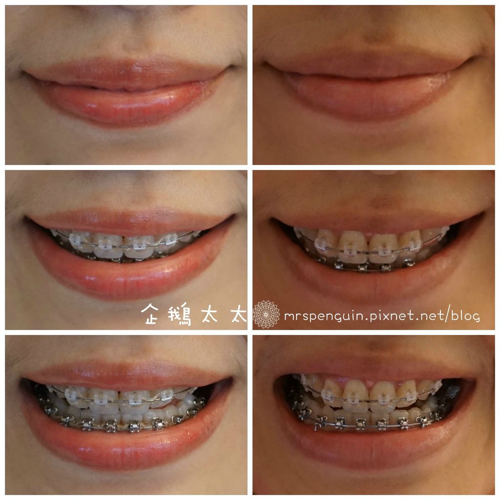 010.7-10.29牙齒比較.jpg