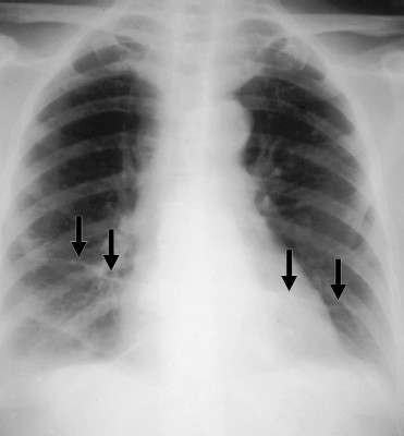 GPULMONARY_EMBOLISM_PE_FIG1.jpg