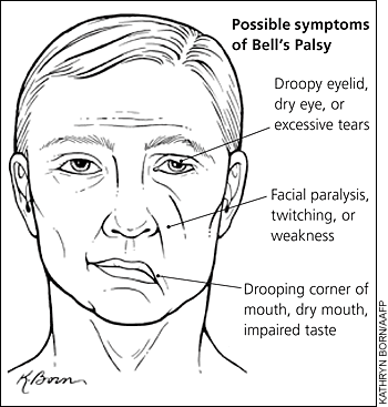 bells-palsy.gif