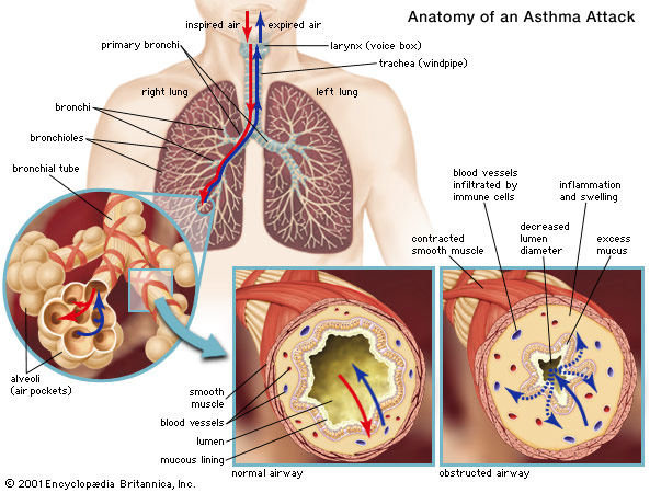 asthma_attack.jpg