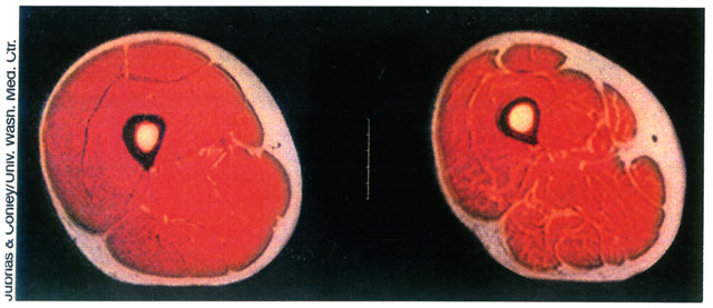 sarcopenia.jpg