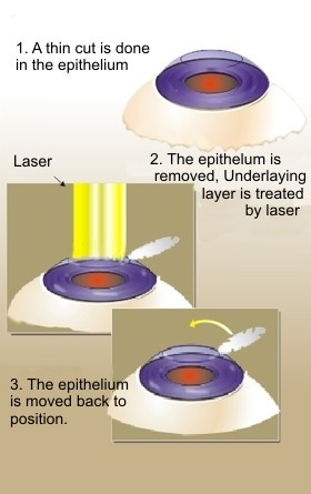 EPI-LASIK.jpg