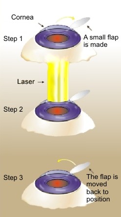 LASIK.jpg