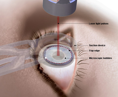 lasek-eye-surgery.jpg