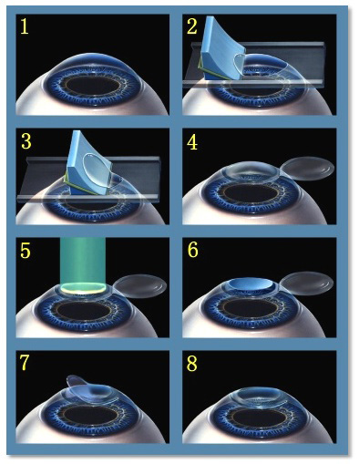 lasik-procedure.jpg