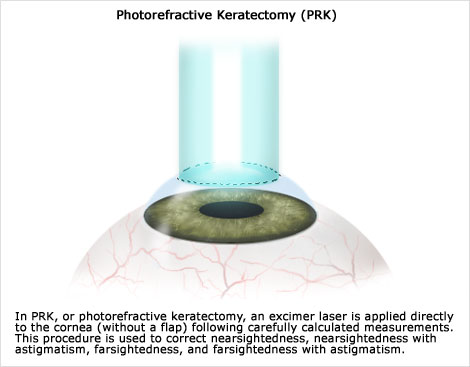 HT_eye_surgeries_prk_0630.jpg