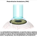 HT_eye_surgeries_prk_0630.jpg