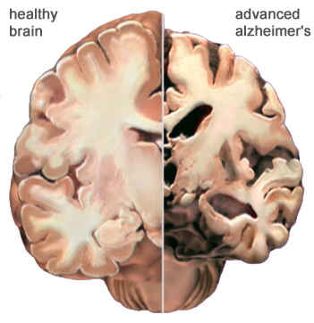 alzheimer_brain