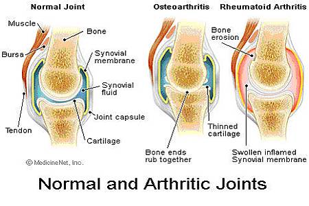 rheumatoid