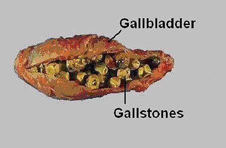 gallbladder