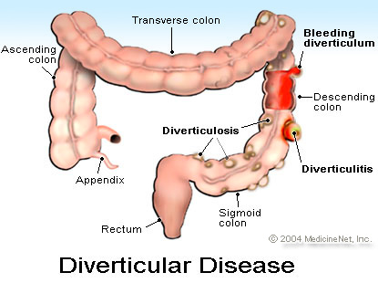 diverticular