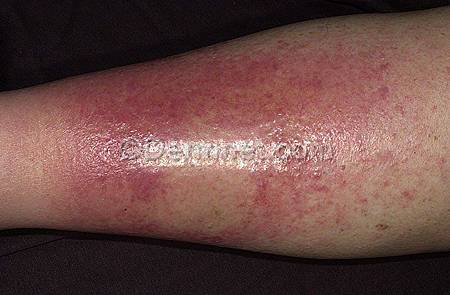 Cellulitis-7