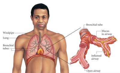 bronchitis_3.3