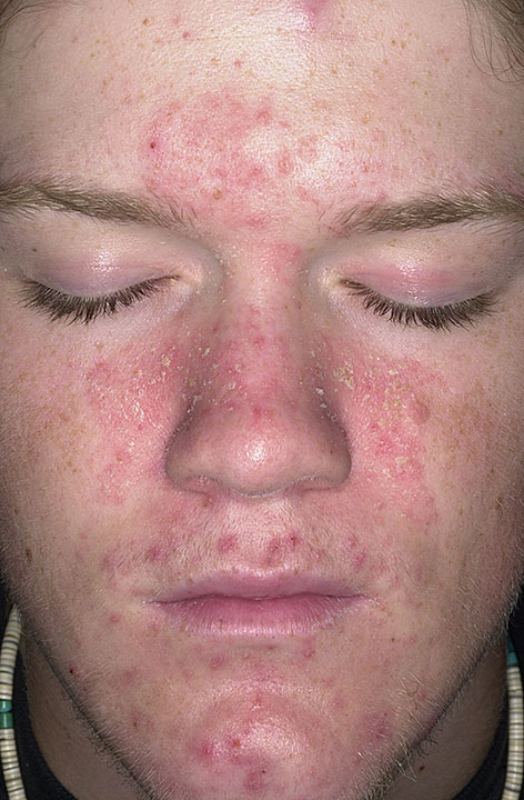 seborrheic_dermatitis_119