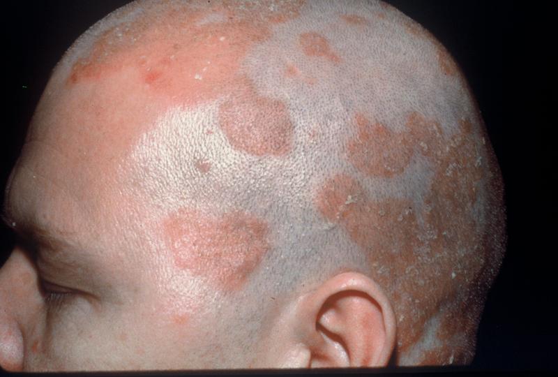 seborrheic-dermatitis_19767667444ead8cd68cfe6