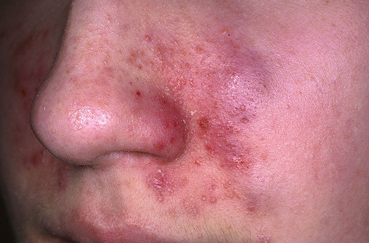 seborrheic-dermatitis-on-face