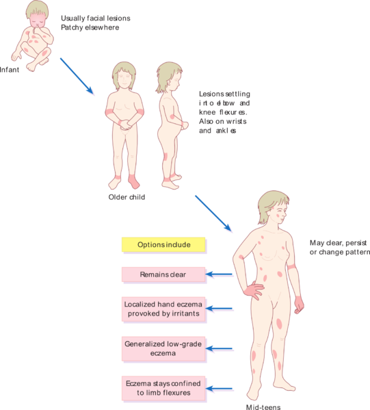 541px-Pattern_of_atopic_eczema_varies_with_age