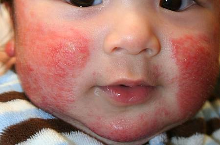 atopic_dermatitis_3_080322