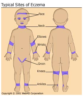 atopic_dermatitis