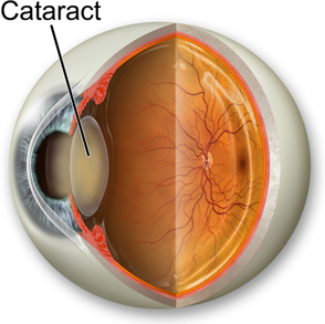 cataract