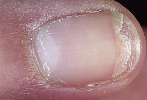 dermnet_photo_of_split_fingernail