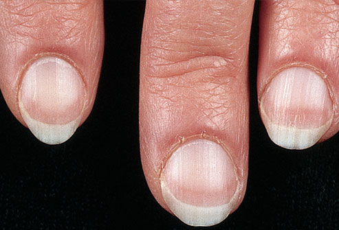 mh_photo_of_pale_fingernails