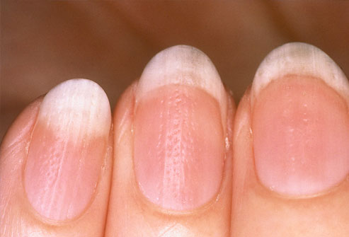 phototake_rm_photo_of_pitted_nails