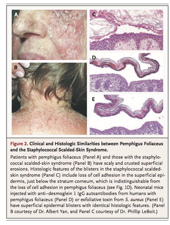 nejmra0611112