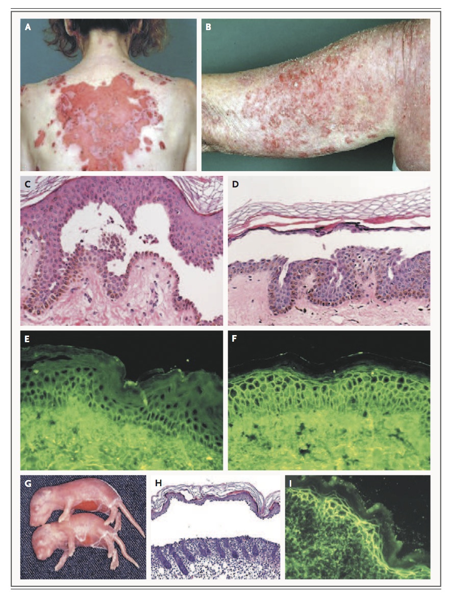 nejmra061111