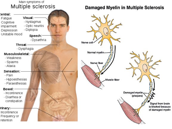 Multiple-Sclerosis