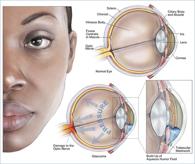 glaucoma.jpg