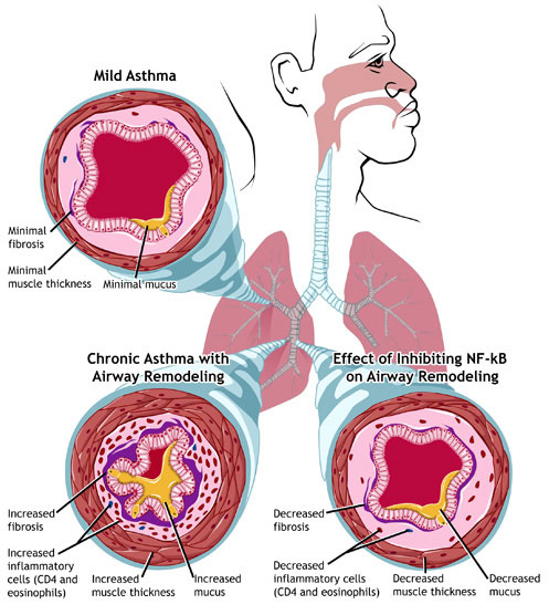 asthma