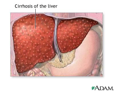 Cirrhosis.jpg