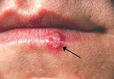 230px-Herpes(PHIL_1573_lores).jpg