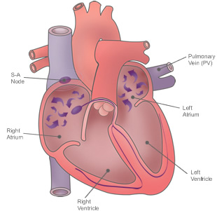 atrial_fibrillation