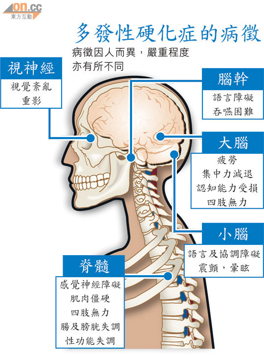 多發性硬化症的病徵