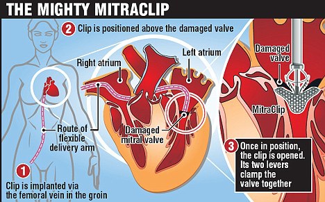 MitraClip