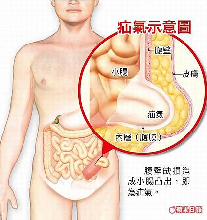 「疝氣」的圖片搜尋結果