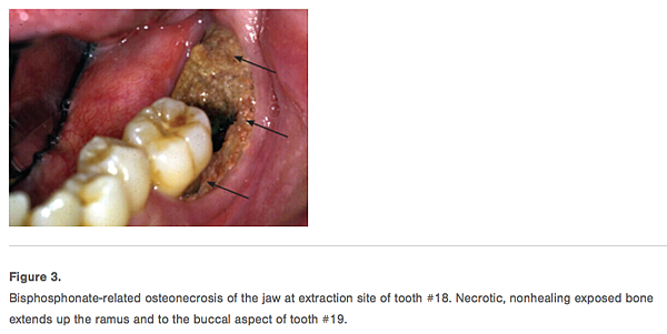 Bisphosphonate-related osteonecrosis of the jaw