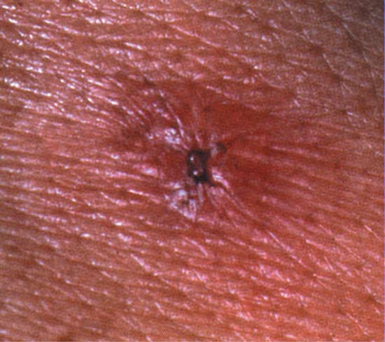 恙虫病焦痂图片.jpg 恙虫病焦痂图片.jpg