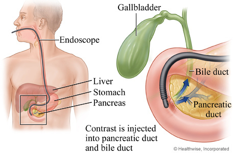 膽管炎cholangitis 快樂小藥師im Pharmacist Nichts Glucklich 痞客邦