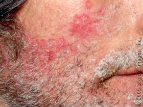 seborrheicDermatitis_43908_lg