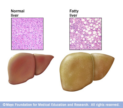 Non_Alcoholic_Fatty_Liver_Disease.jpg