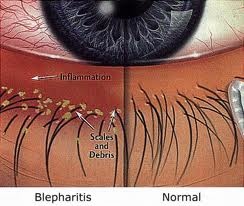 blepharitis pictoral.jpg