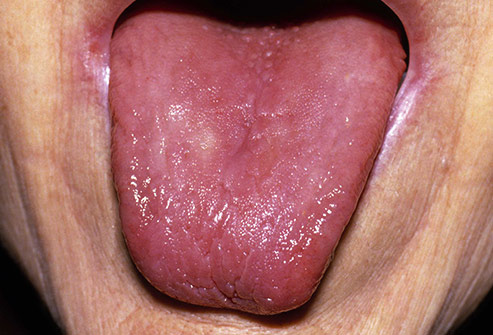 493ss_medical_images_rm_bald_tongue.jpg