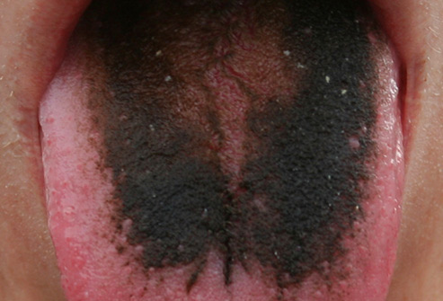 493ss_wikimedia_rf_black_hairy_tongue.jpg