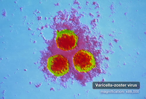 PRinc_photo_of_varicella_zoster_virus.jpg